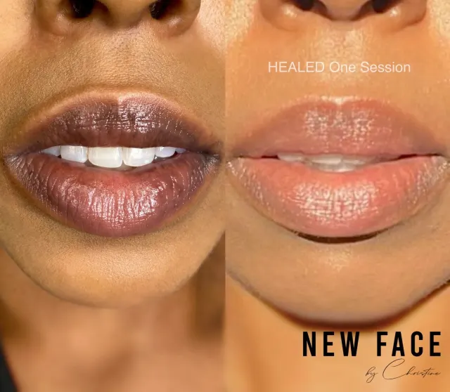 Dark Lips Neutralization result by New Face by Christine, NYC — photo 55