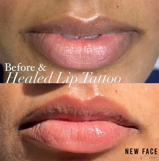 Dark Lips Neutralization result by New Face by Christine, NYC — photo 56