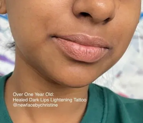 Dark Lips Neutralization result by New Face by Christine, NYC — photo 57