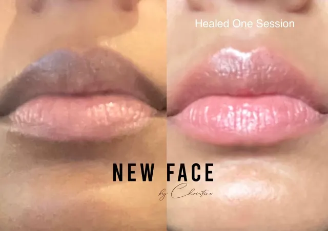 Dark Lips Neutralization result by New Face by Christine, NYC — photo 58