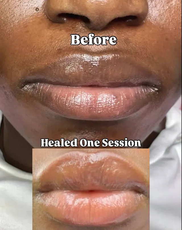 Dark Lips Neutralization result by New Face by Christine, NYC — photo 59