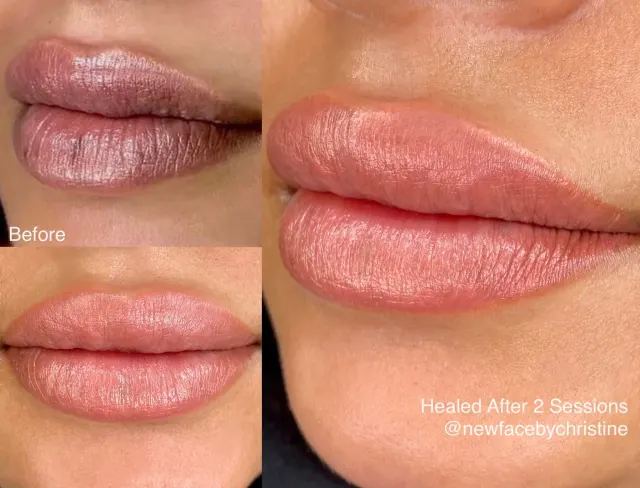 Dark Lips Neutralization result by New Face by Christine, NYC — photo 60