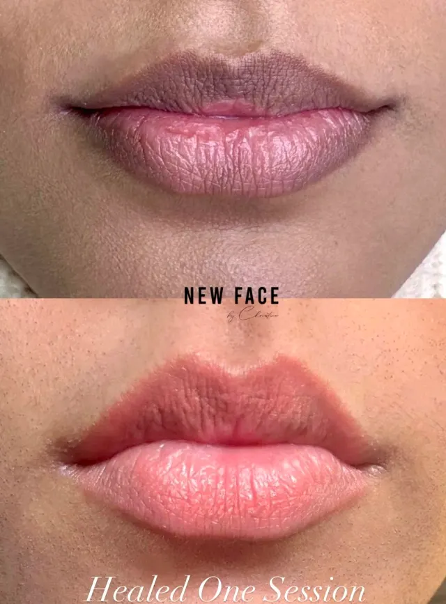 Dark Lips Neutralization result by New Face by Christine, NYC — photo 62