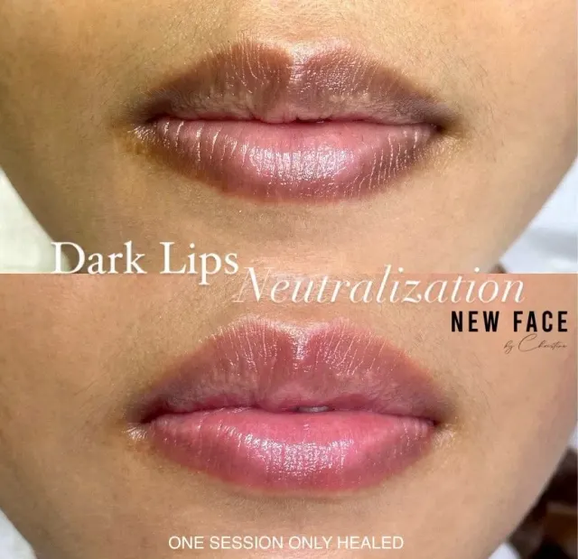 Dark Lips Neutralization result by New Face by Christine, NYC — photo 63