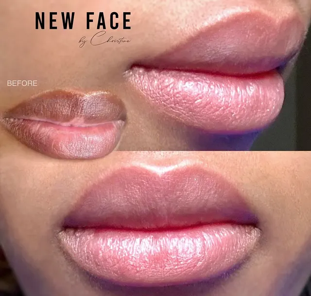 Dark Lips Neutralization result by New Face by Christine, NYC — photo 64