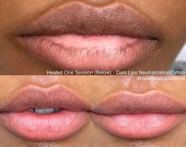 Dark Lips Neutralization result by New Face by Christine, NYC — photo 65