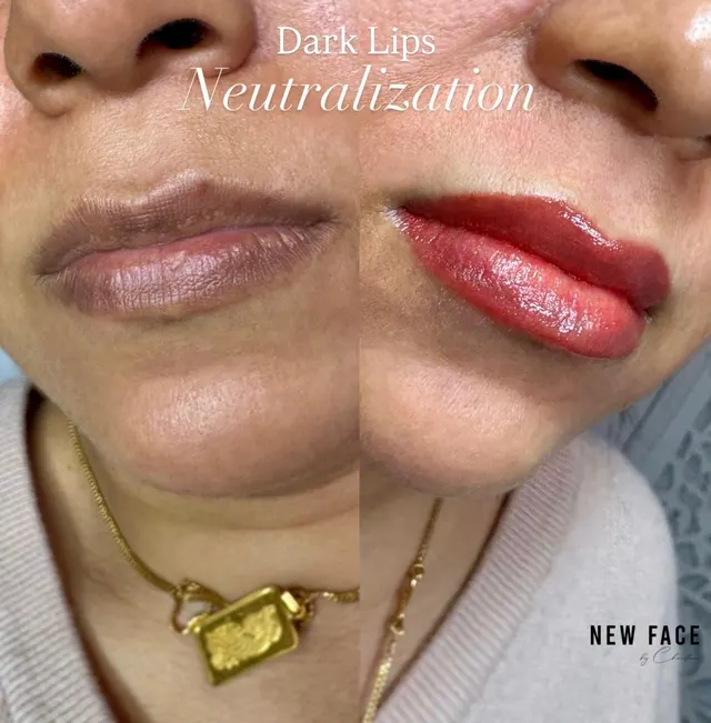 Dark Lips Neutralization result by New Face by Christine, NYC — photo 66