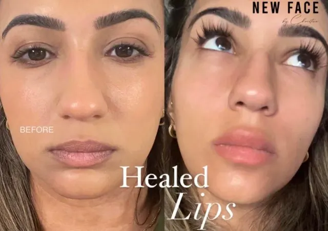 Dark Lips Neutralization result by New Face by Christine, NYC — photo 68