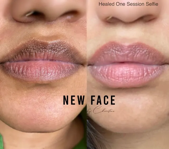 Dark Lips Neutralization result by New Face by Christine, NYC — photo 69