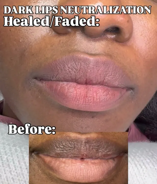 Dark Lips Neutralization result by New Face by Christine, NYC — photo 70