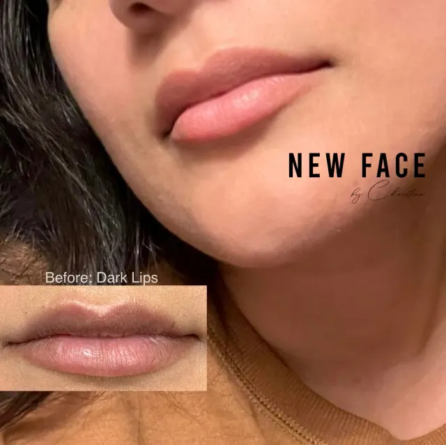 Dark Lips Neutralization result by New Face by Christine, NYC — photo 71
