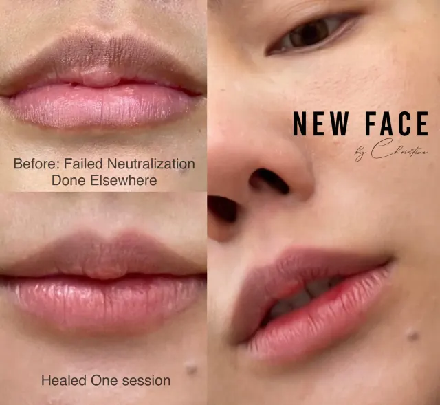 Dark Lips Neutralization result by New Face by Christine, NYC — photo 72