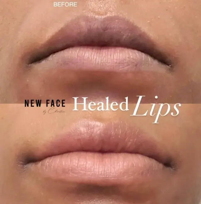 Dark Lips Neutralization result by New Face by Christine, NYC — photo 75