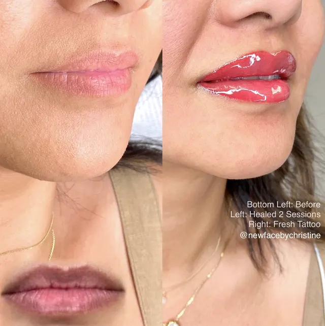 Dark Lips Neutralization result by New Face by Christine, NYC — photo 77
