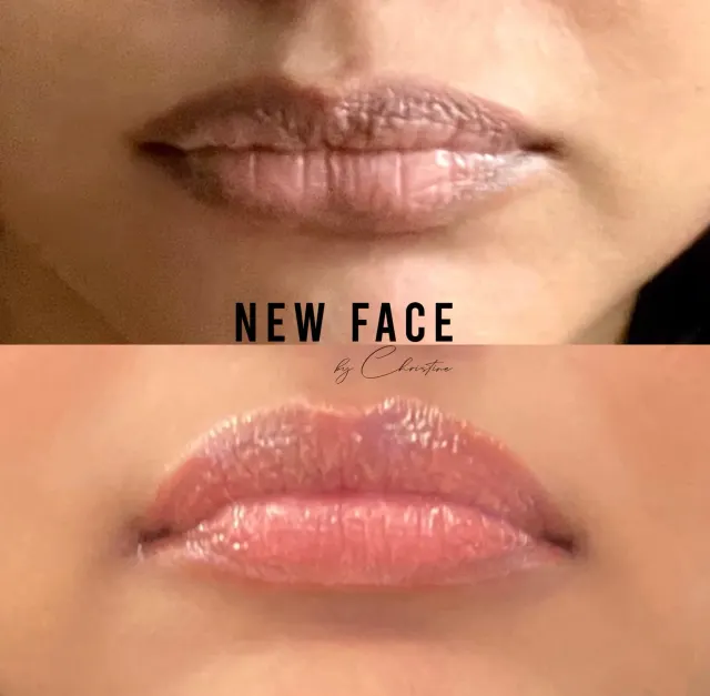 Dark Lips Neutralization result by New Face by Christine, NYC — photo 78