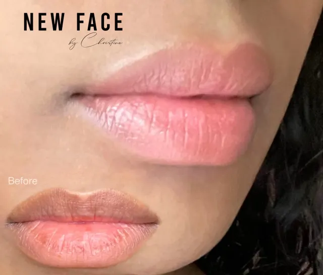 Dark Lips Neutralization result by New Face by Christine, NYC — photo 79