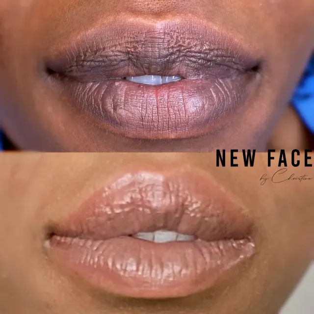 Dark Lips Neutralization result by New Face by Christine, NYC — photo 80