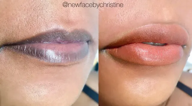 Dark Lips Neutralization result by New Face by Christine, NYC — photo 81