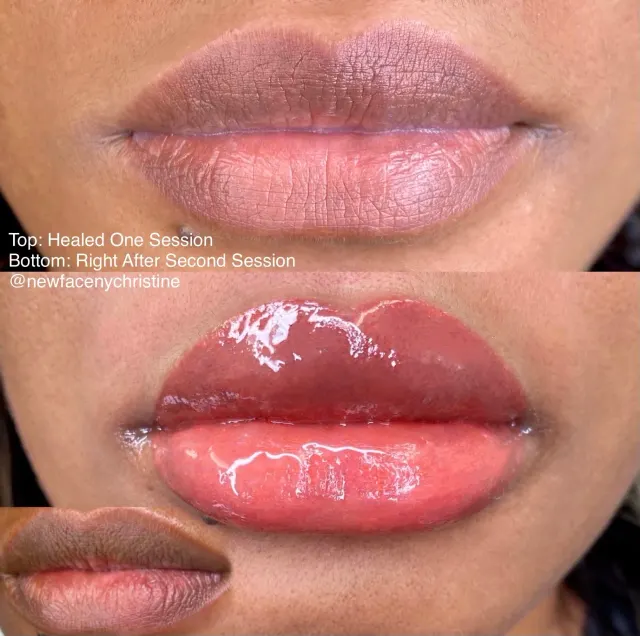 Dark Lips Neutralization result by New Face by Christine, NYC — photo 82