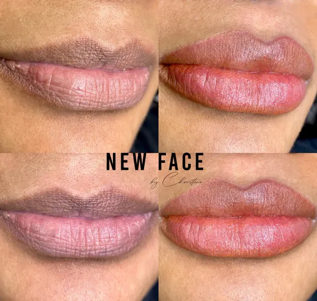 Dark Lips Neutralization result by New Face by Christine, NYC — photo 84