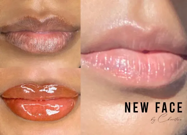 Dark Lips Neutralization result by New Face by Christine, NYC — photo 85