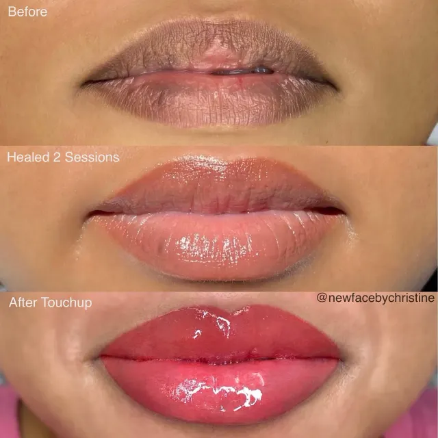 Dark Lips Neutralization result by New Face by Christine, NYC — photo 87