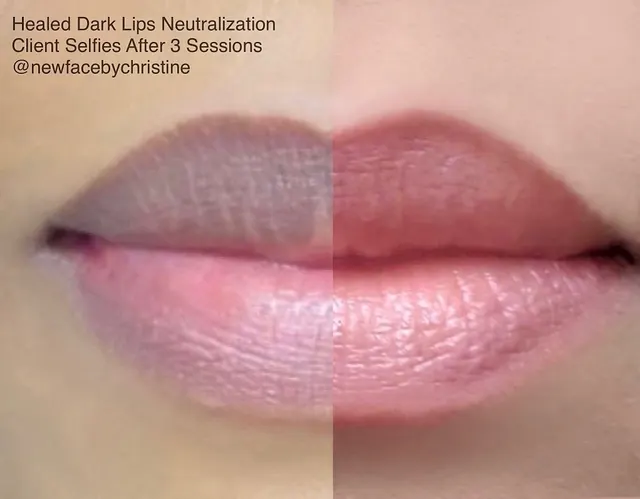 Dark Lips Neutralization result by New Face by Christine, NYC — photo 90