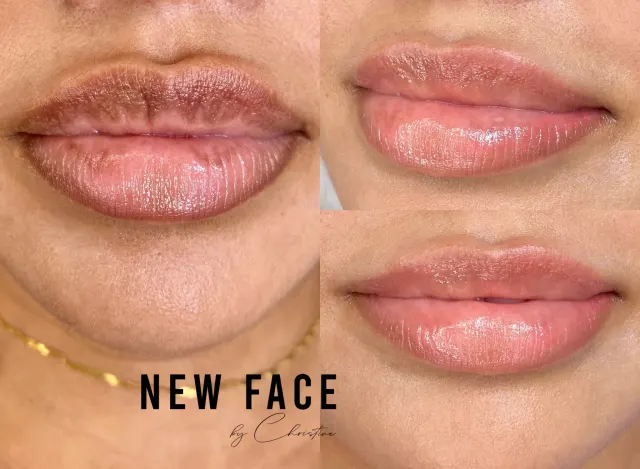 Dark Lips Neutralization result by New Face by Christine, NYC — photo 91