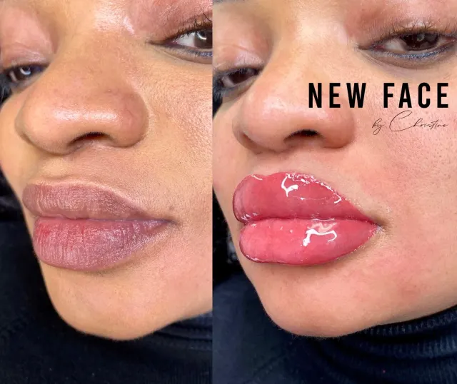 Dark Lips Neutralization result by New Face by Christine, NYC — photo 92
