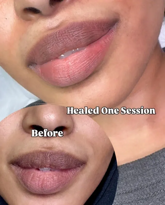 Dark Lips Neutralization result by New Face by Christine, NYC — photo 93