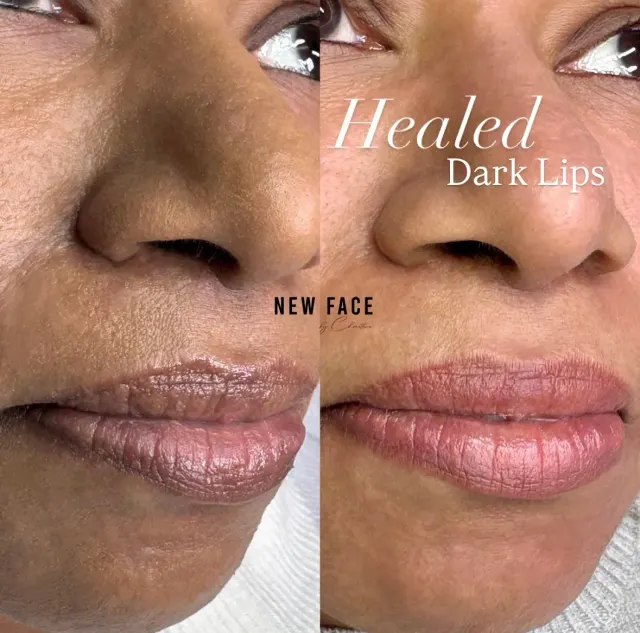 Dark Lips Neutralization result by New Face by Christine, NYC — photo 94