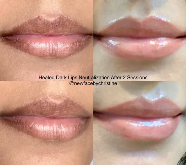 Dark Lips Neutralization result by New Face by Christine, NYC — photo 96