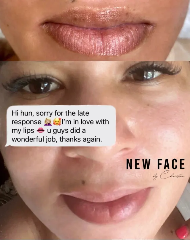 Dark Lips Neutralization result by New Face by Christine, NYC — photo 97