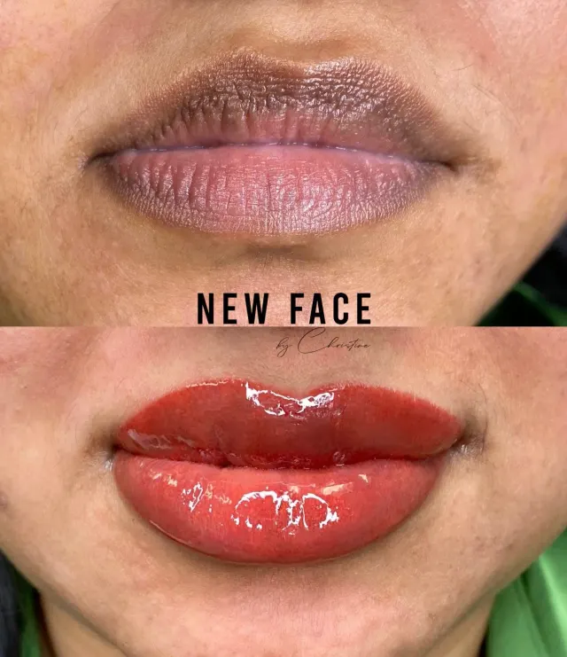Dark Lips Neutralization result by New Face by Christine, NYC — photo 98