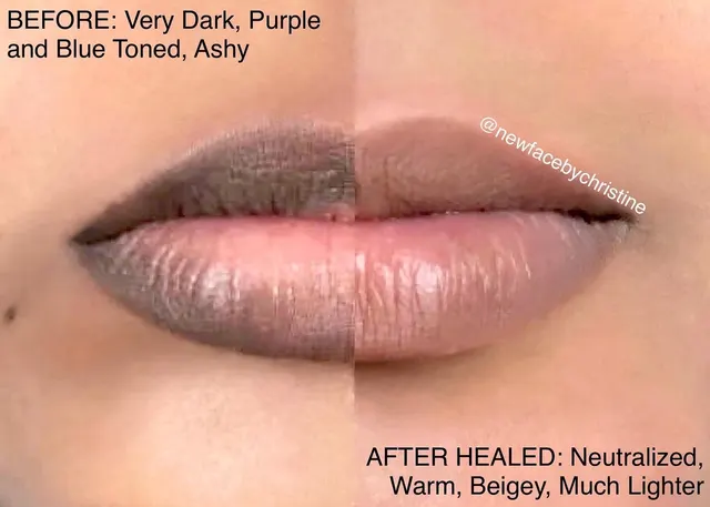 Dark Lips Neutralization result by New Face by Christine, NYC — photo 99