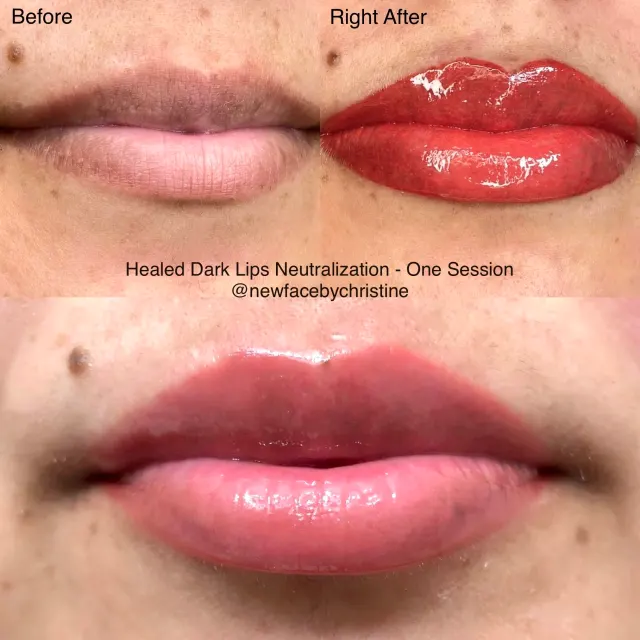 Dark Lips Neutralization result by New Face by Christine, NYC — photo 100