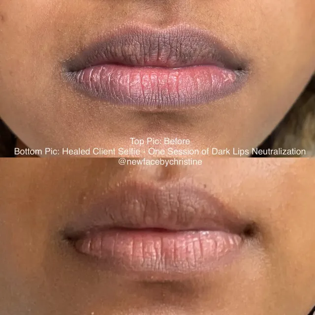 Dark Lips Neutralization result by New Face by Christine, NYC — photo 101