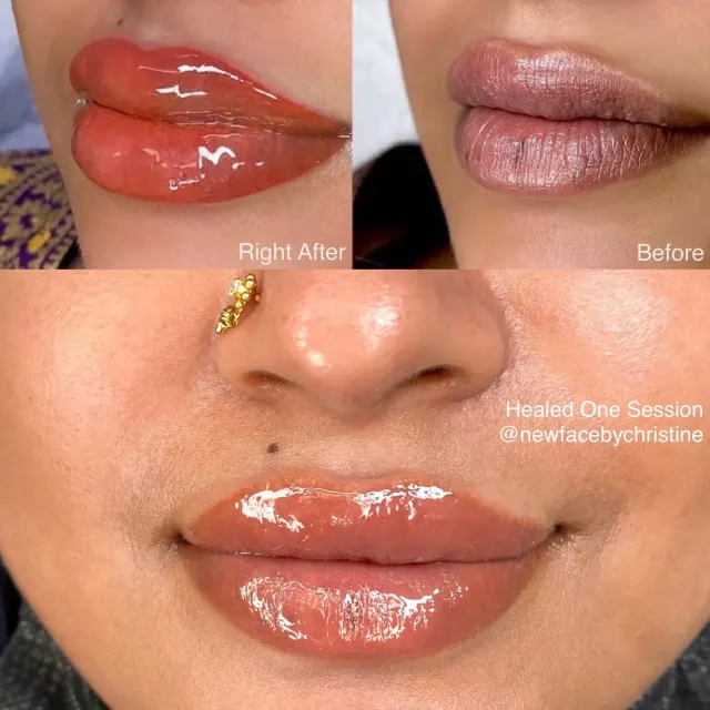 Dark Lips Neutralization result by New Face by Christine, NYC — photo 102