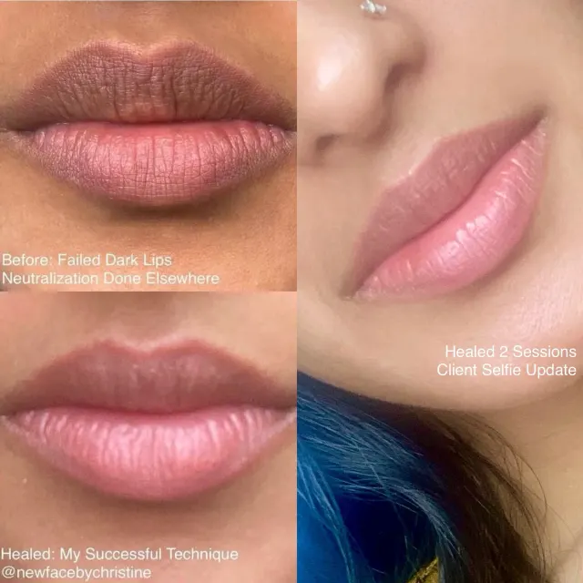 Dark Lips Neutralization result by New Face by Christine, NYC — photo 103