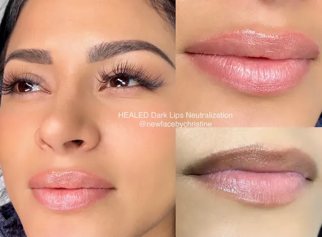 Dark Lips Neutralization result by New Face by Christine, NYC — photo 104