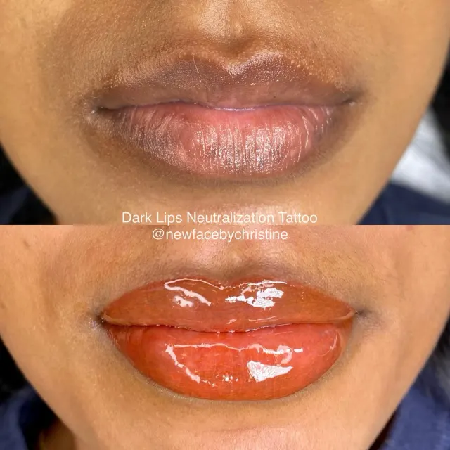 Dark Lips Neutralization result by New Face by Christine, NYC — photo 105
