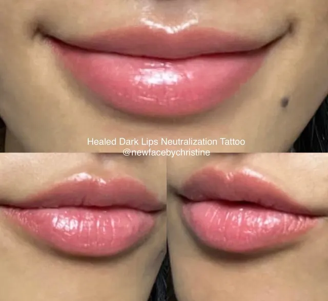 Dark Lips Neutralization result by New Face by Christine, NYC — photo 108