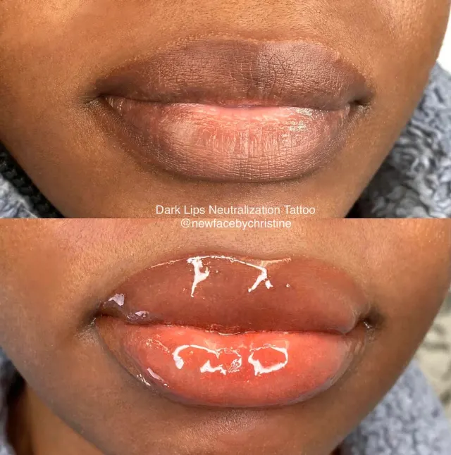 Dark Lips Neutralization result by New Face by Christine, NYC — photo 110