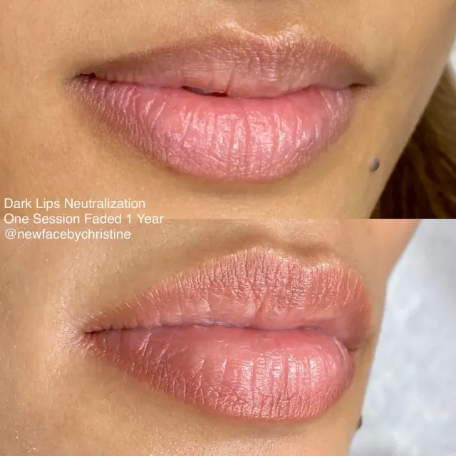 Dark Lips Neutralization result by New Face by Christine, NYC — photo 111