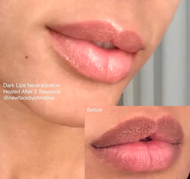 Dark Lips Neutralization result by New Face by Christine, NYC — photo 112
