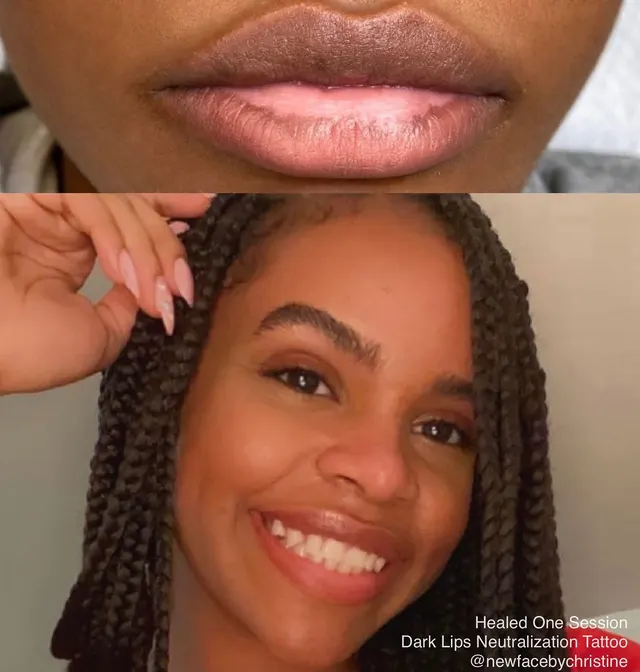 Dark Lips Neutralization result by New Face by Christine, NYC — photo 115