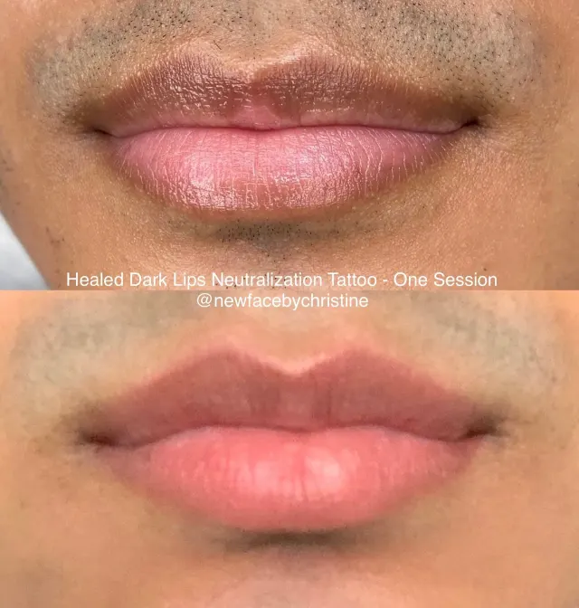 Dark Lips Neutralization result by New Face by Christine, NYC — photo 117