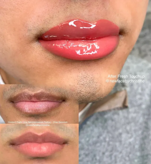 Dark Lips Neutralization result by New Face by Christine, NYC — photo 118