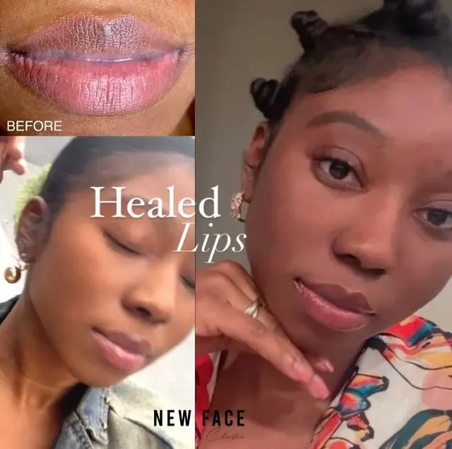 Dark Lips Neutralization result by New Face by Christine, NYC — photo 119