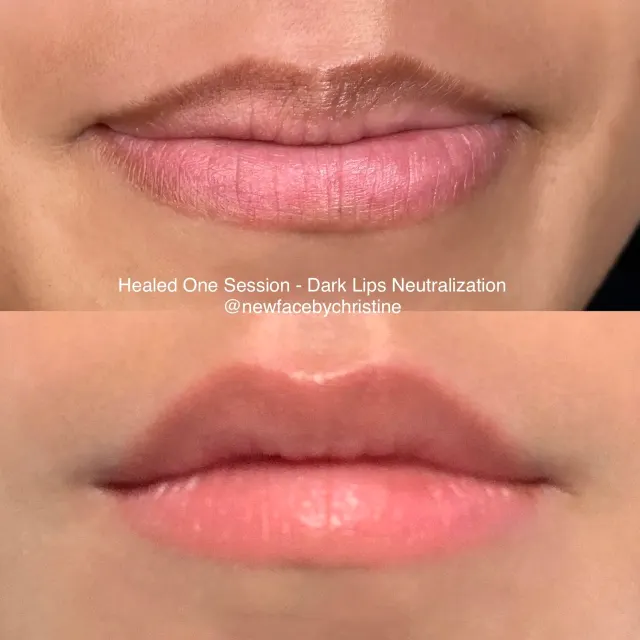 Dark Lips Neutralization result by New Face by Christine, NYC — photo 121